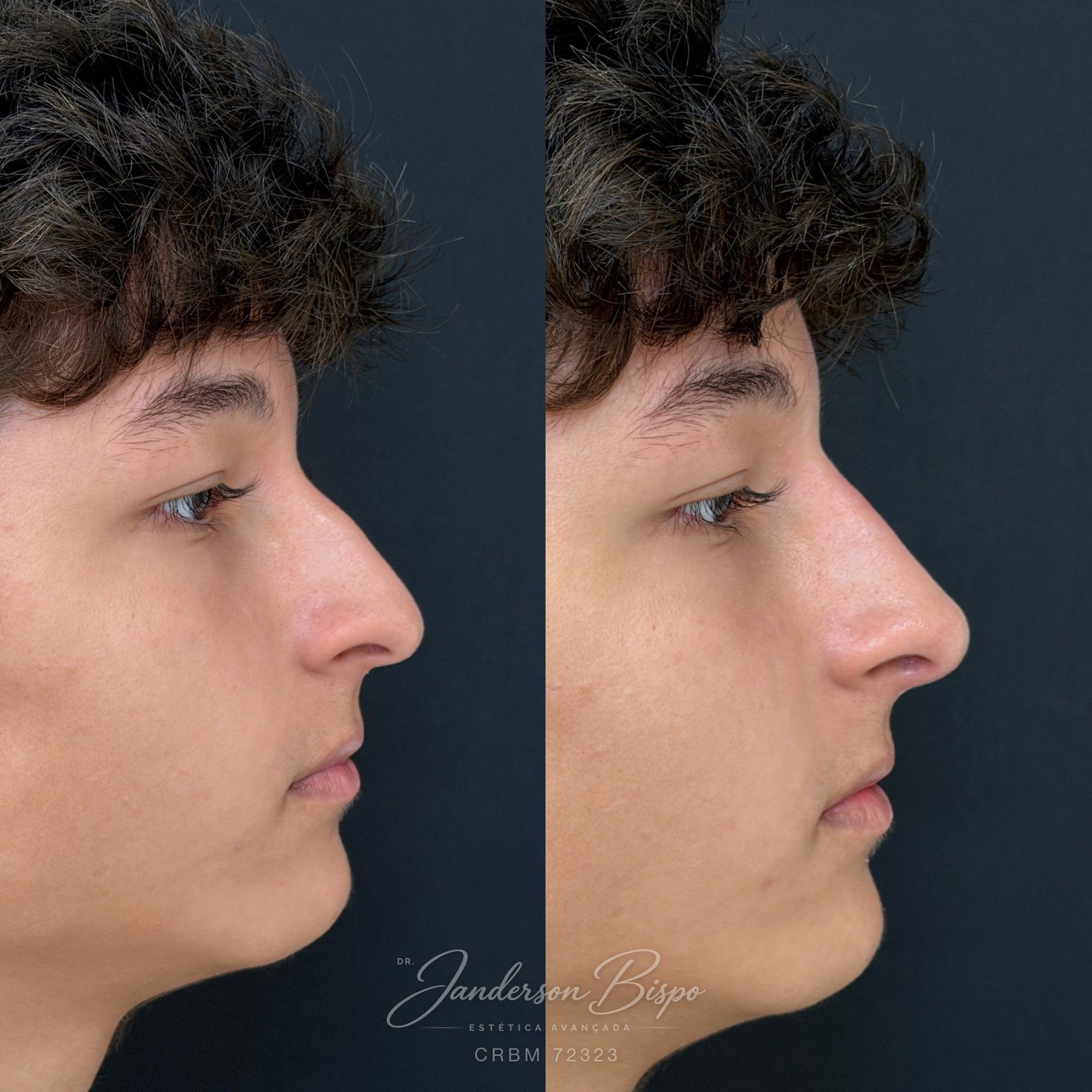 Antes e depois de rinomodelação — perfil do dorso e ponta nasal