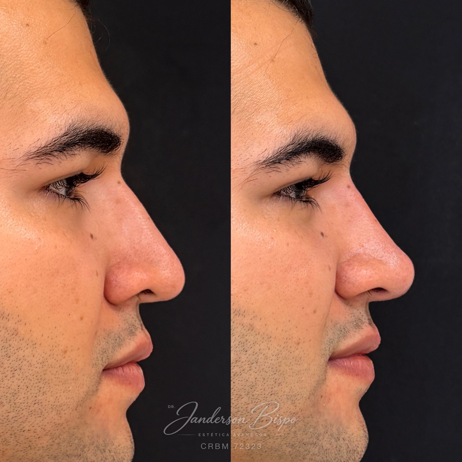 Antes e depois de rinomodelação — correção do dorso no perfil