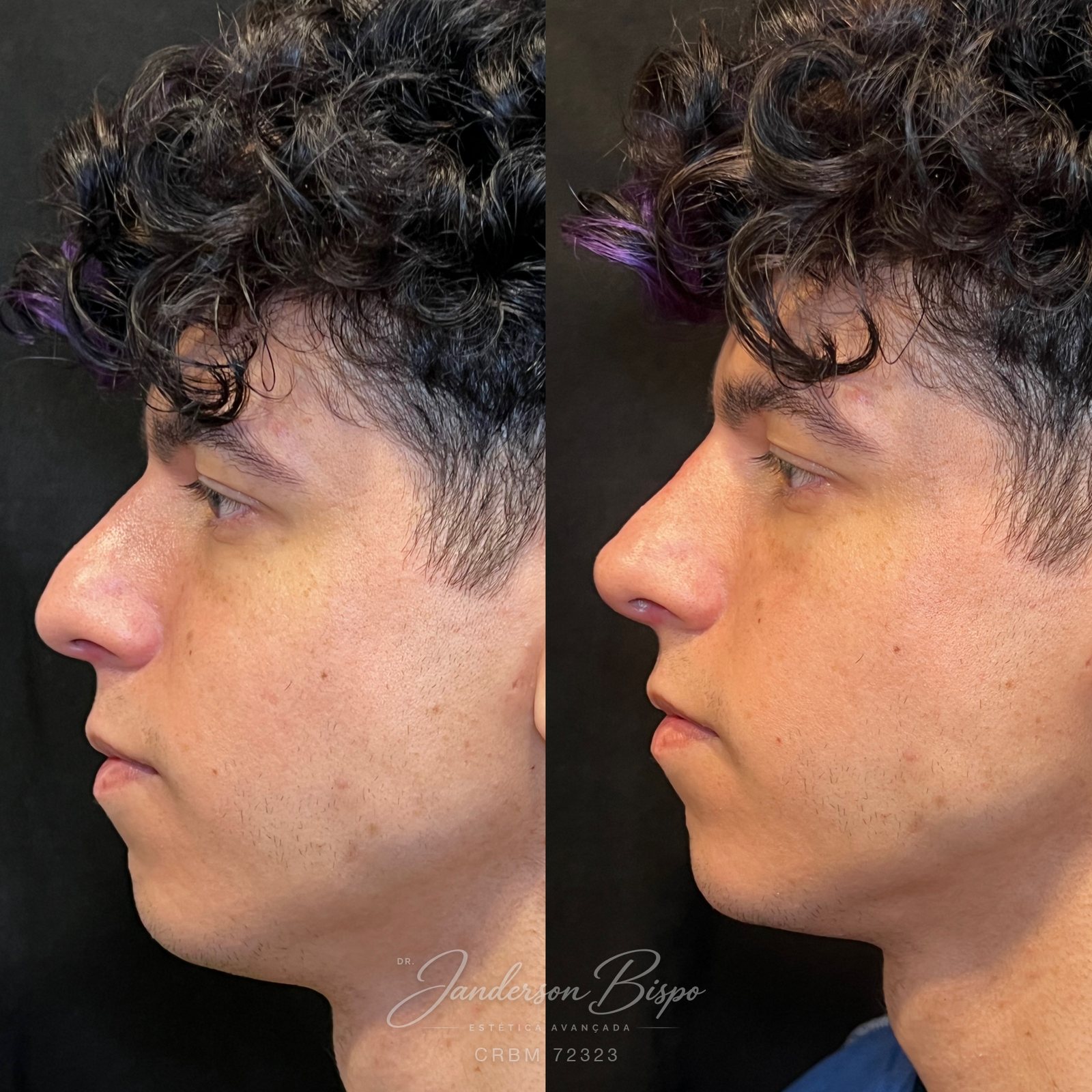 Antes e depois de rinomodelação — ponta nasal e transição do dorso
