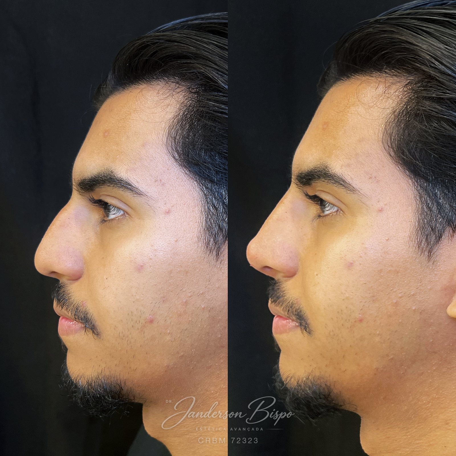 Antes e depois de rinomodelação — dorso e ponta no perfil