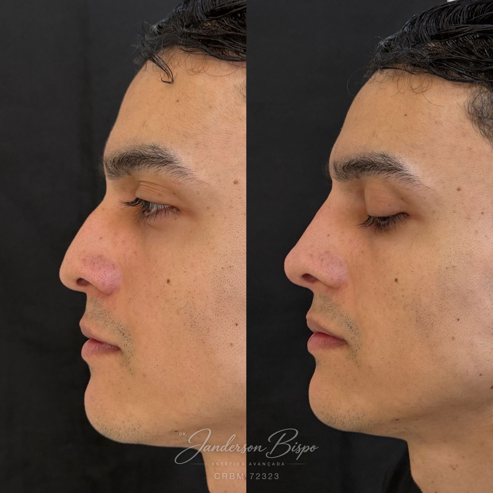 Antes e depois de rinomodelação — suavização do dorso nasal